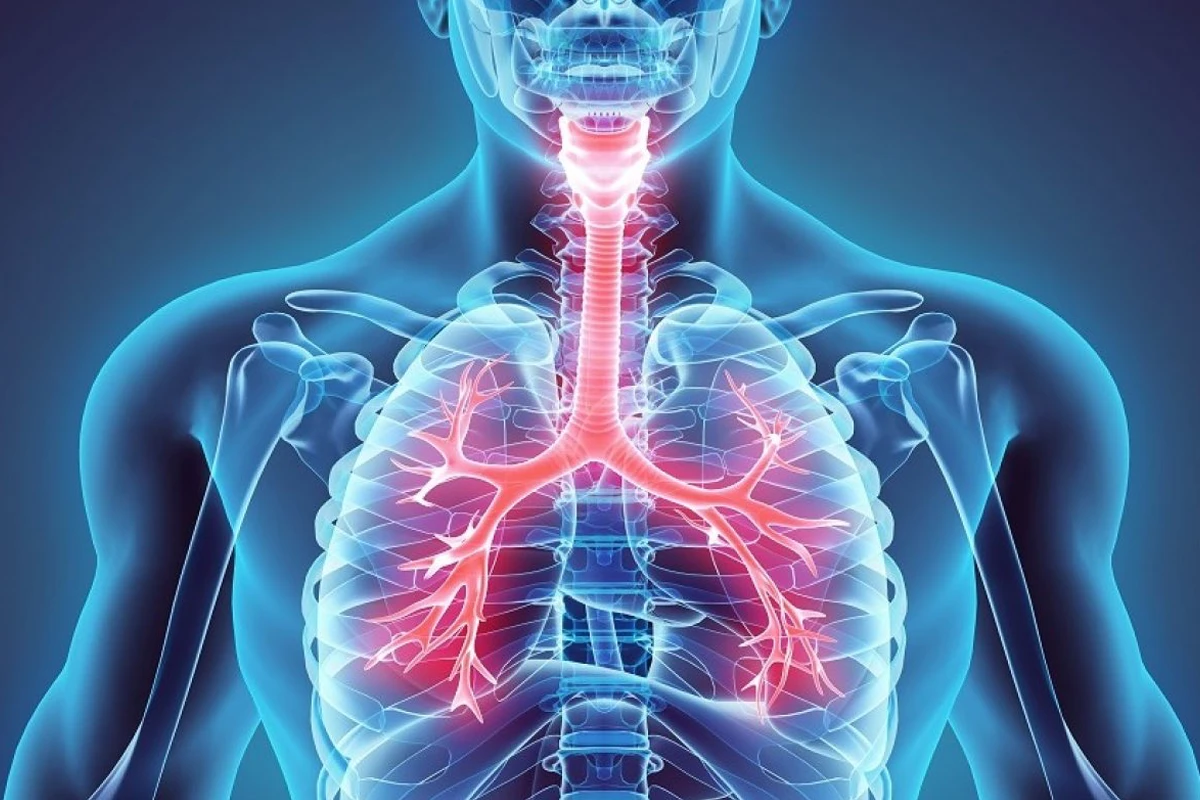 Anatomische 3D-Grafik der Lunge mit Entzündung der Bronchien – Symbolbild für die chronisch obstruktive Lungenerkrankung COPD.