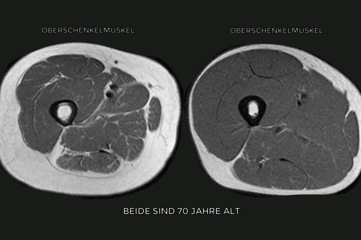 Vergleich zweier MRT-Bilder von Oberschenkelmuskeln eines jungen und eines 70-jährigen Menschen – Symbolbild für altersbedingten Muskelschwund (Sarkopenie).