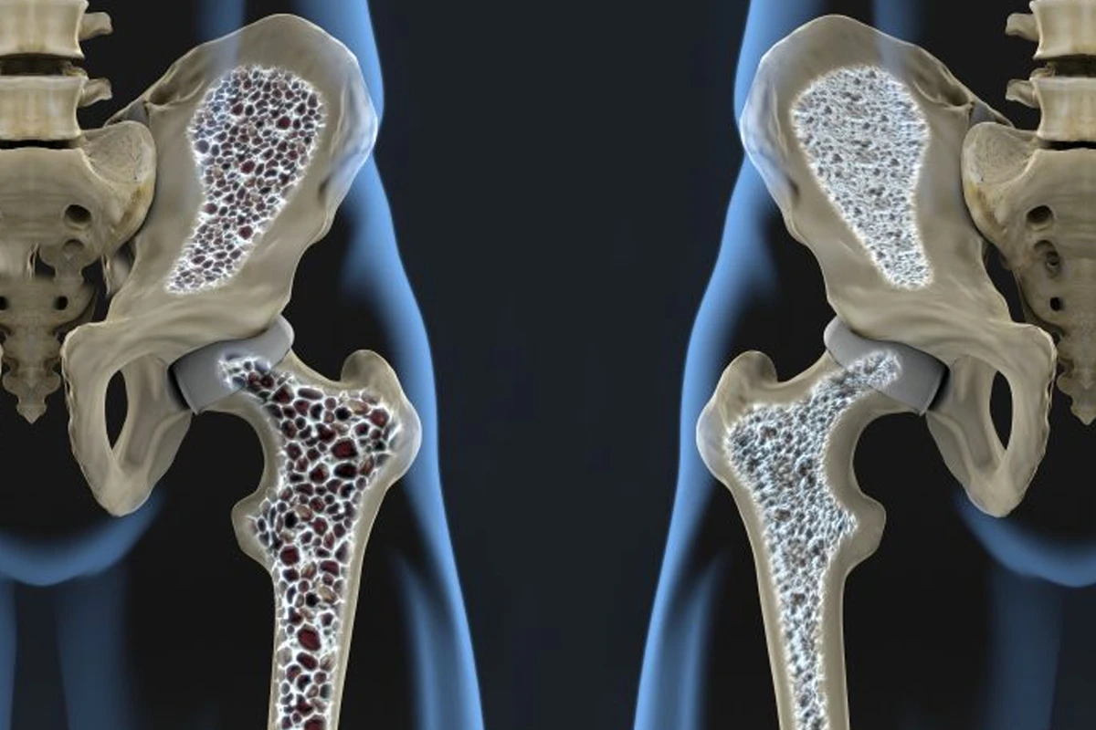 Vergleich gesunder und osteoporotischer Oberschenkelknochen – Visualisierung der Knochendichteverringerung bei Osteoporose.